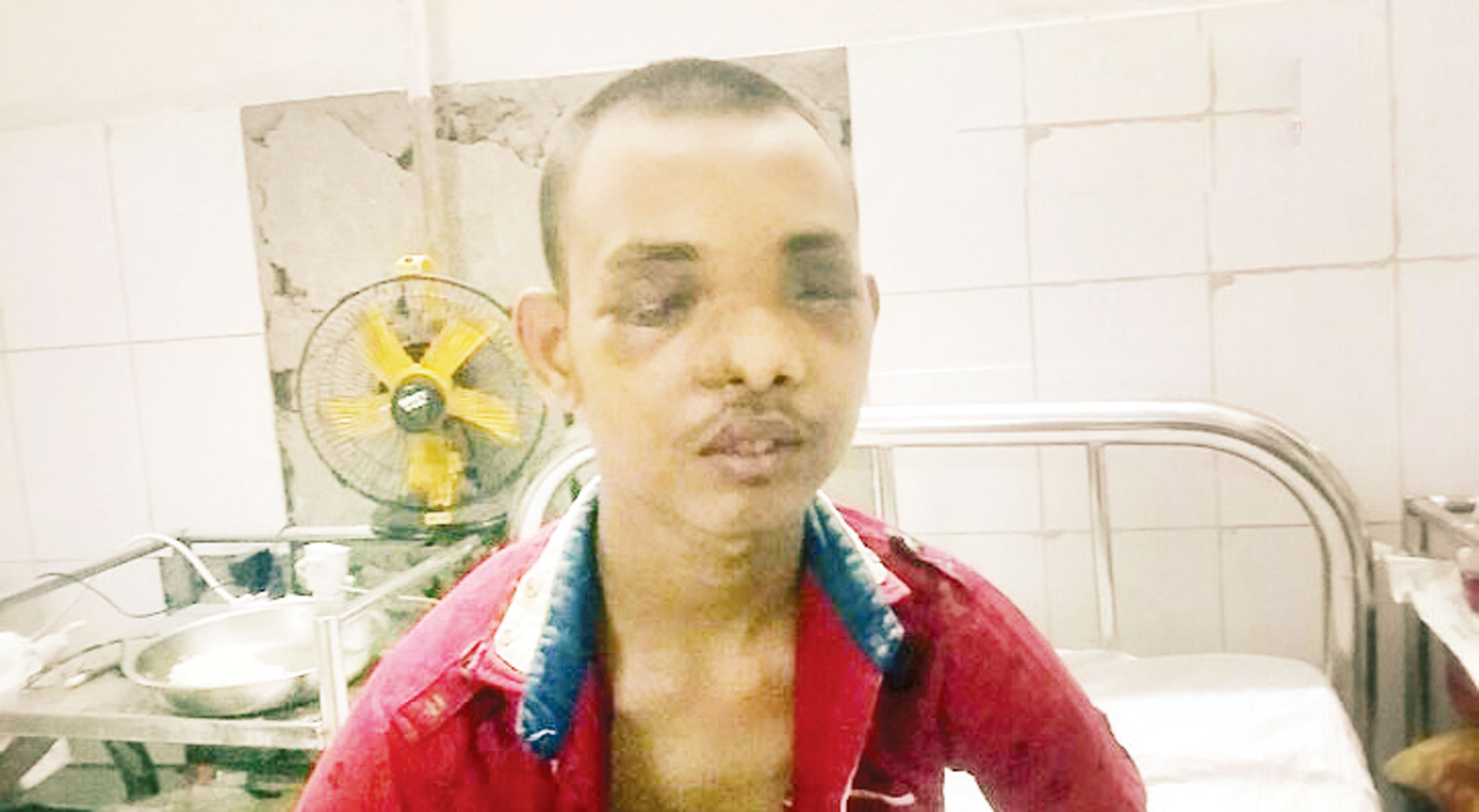 স্ক্রু ড্রাইভার দিয়ে কিশোরের চোখ তুলে নিল চাচাত ভাই