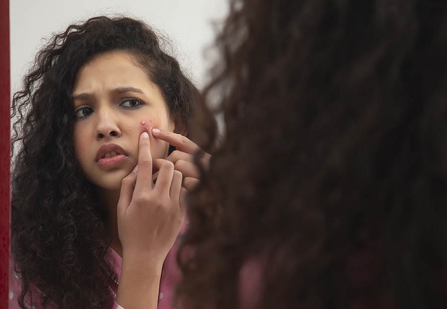 ​মাস্ক পরে থাকায় ব্রণ হলে কী করবেন