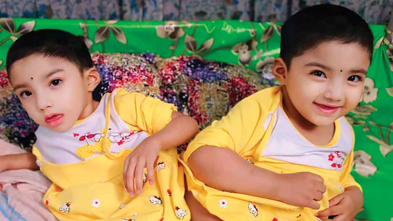 ১৫ ঘণ্টা অস্ত্রোপচারের পর আলাদা হলো নুহা ও নাভা