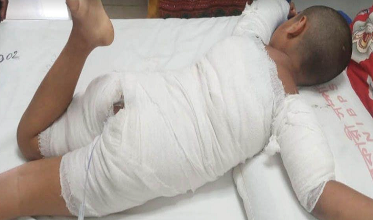 সোনারগাঁওয়ে ৭ বছরের শিশুকে পুড়িয়ে হত্যার চেষ্টা