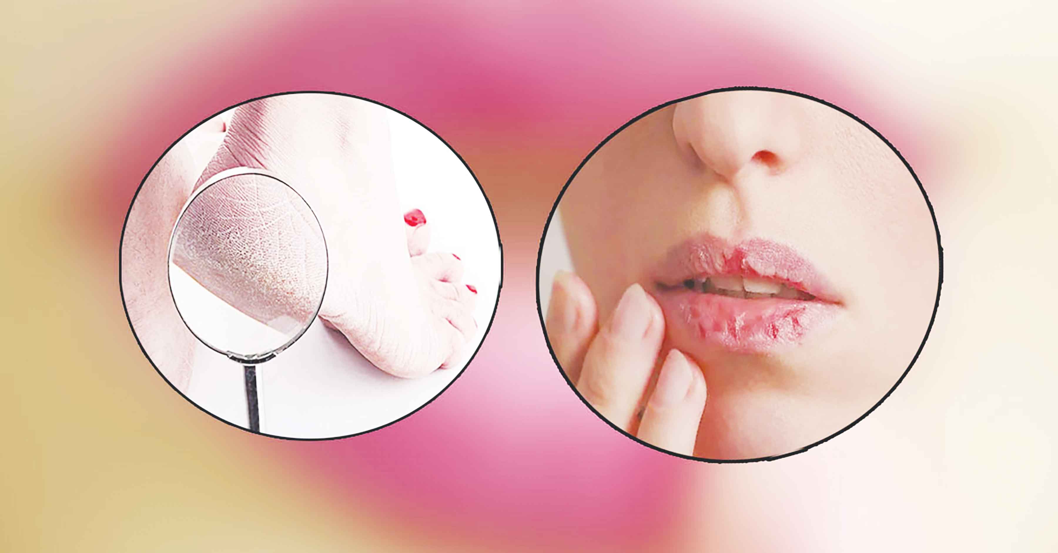 পা ও ঠোঁট ফাটার কারণ ও চিকিৎসা